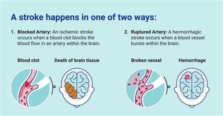 Pioneer Woman: Understanding The Stroke Cause Of Death