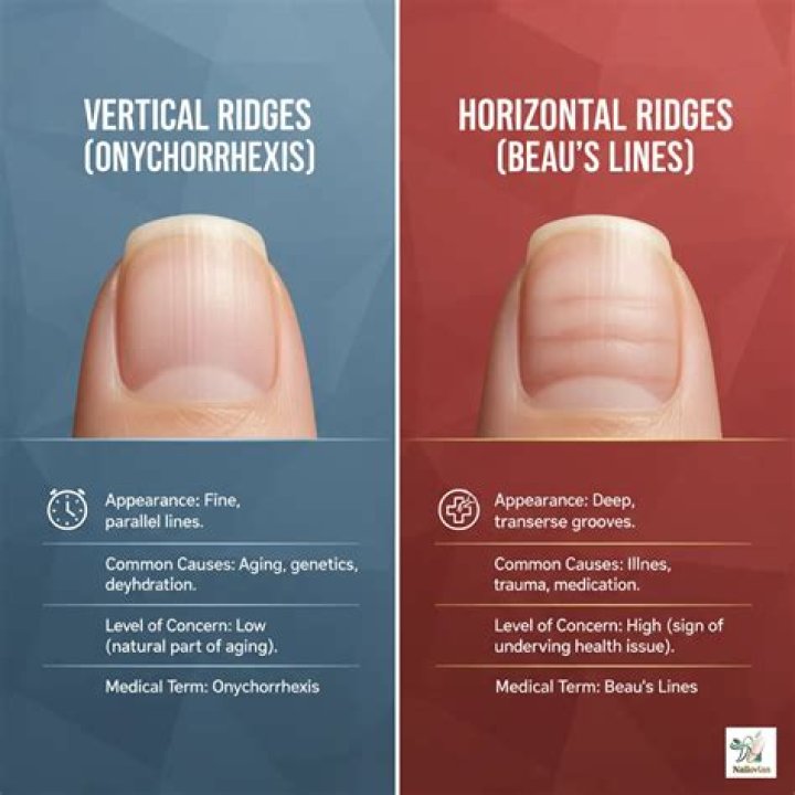 Understanding Horizontal Ridges In Nails: What They Indicate About Your Health